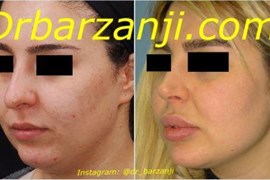 پروتز چانه و زاویه فک