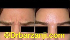 بهبودی خط اخم با تزریق بوتاکس ( دیسپورت )