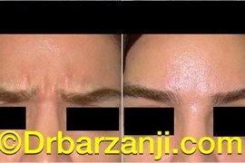 بهبودی خط اخم با تزریق بوتاکس ( دیسپورت )