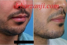 پروتز چانه
