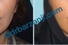 عمل جراحی پروتز چانه