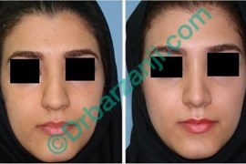 جراحی بینی ٦ ماه بعد از عمل