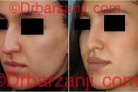 عکس عمل جراحی پلاستیک بینی ۶ ماه بعد