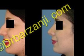 جراحی بینی سه ماه بعد از عمل