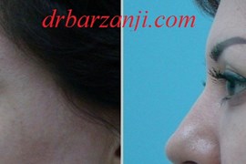 تزریق ژل بلوترو در فرورفتگی زیر چشم