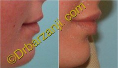 تزریق ژل جوویدرم در لب 