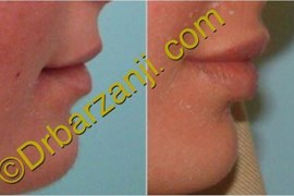 تزریق ژل جوویدرم در لب 