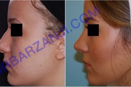 جراحی بینی، یک سال بعد از عمل