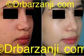 جراحی پلاستیک با پیوند غضروف دنده به بینی
