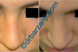 تزریق ژل رادیس در محل فرورفتگی بینی بعد از عمل