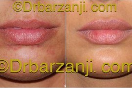 تزریق ژل جوویدرم  (ژوویدرم )در لب ، 9 ماه بعد