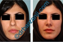 جراحی بینی یک ماه بعد از عمل