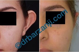 جراحی برجستگی لاله گوش
