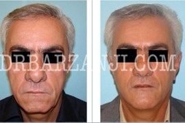 فیس لیفت و پروتز چانه