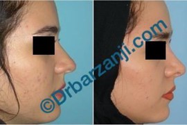 جراحی پلاستیک بینی نه ماه بعد از عمل