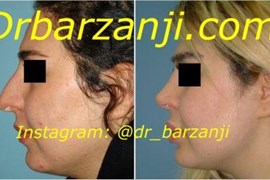 جراحی بینی و پروتز چانه