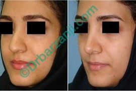 جراحی بینی ٦ ماه بعد از عمل