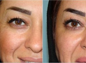 تزریق بوتاکس