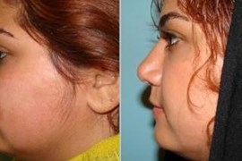 پارگی و شکستگی بینی 8 