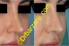 تزریق ژل رستیلن در بینی عمل شده