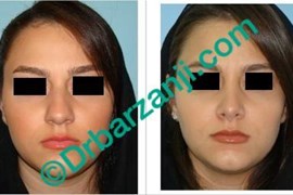 عمل جراحی پلاستیک بینی یک سال بعد