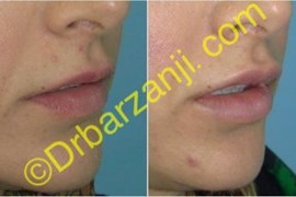 تزریق ژل جوویدرم  ( ژوویدرم ) به لب یک هفته بعد