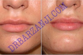 تزریق ژل ژوویدرم به لب ، ٤ ماه بعد