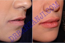 ژل  جوویدرم در لب بالا و پایین، ٥ هفته بعد