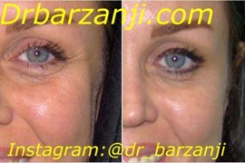 بهبود چین و چروک اطراف چشم با تزریق بوتاکس ( دیسپورت )
