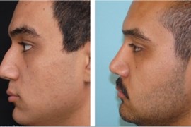 جراحی بینی، یک سال بعد از عمل