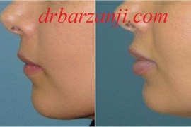 تزریق ژل جوویدرم در لب