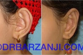 عمل جراحی پلاستیک لاله گوش