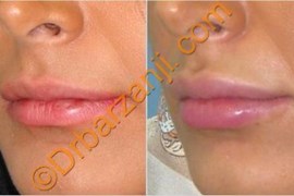 تزریق ژل جوویدرم  ( ژوویدرم ) به لب یک ماه بعد