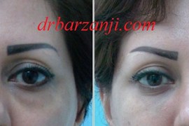 تزریق ژل بلوترو در فرورفتگی زیر چشم