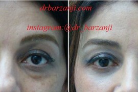 تزریق چربی زیر چشم ها