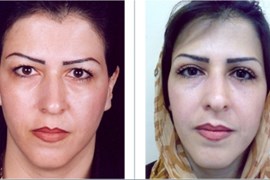 عمل جراحی پلک (بلفاروپلاستی) فوقانی