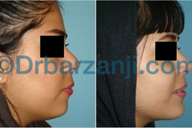پروتز چانه و لیپوساکشن غبغب یک سال و نیم بعد