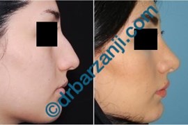 جراحی بینی یک سال و نیم بعد از عمل