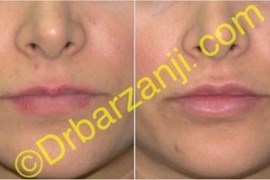 تزریق ژل جوویدرم  ( ژوویدرم ) به لب یک هفته بعد