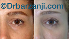 تزریق چربی زیر چشم و جراحی پلک بالا