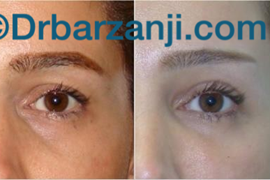 تزریق چربی زیر چشم و جراحی پلک بالا