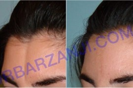 تزریق چربی در پیشانی( فرورفتگی مادرزادی)