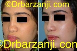جراحی پلاستیک با پیوند غضروف دنده به بینی