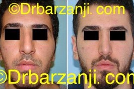 جراحی بینی دو سال بعد از عمل