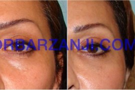 تزریق چربی در فرورفتگی زیر چشم