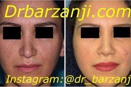 جراحی ترمیمی بینی چهار ماه بعد از عمل