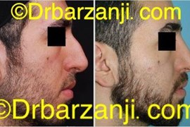 جراحی بینی دو سال بعد از عمل