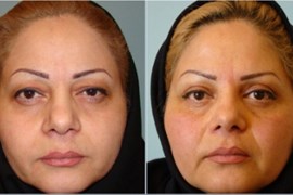 عمل جراحی پلک (بلفاروپلاستی) فوقانی