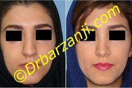 جراحی زیبایی بینی