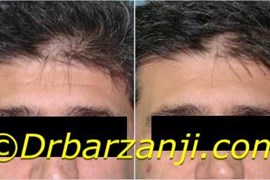 کاهش خطوط پیشانی با تزریق بوتاکس ( دیسپورت )